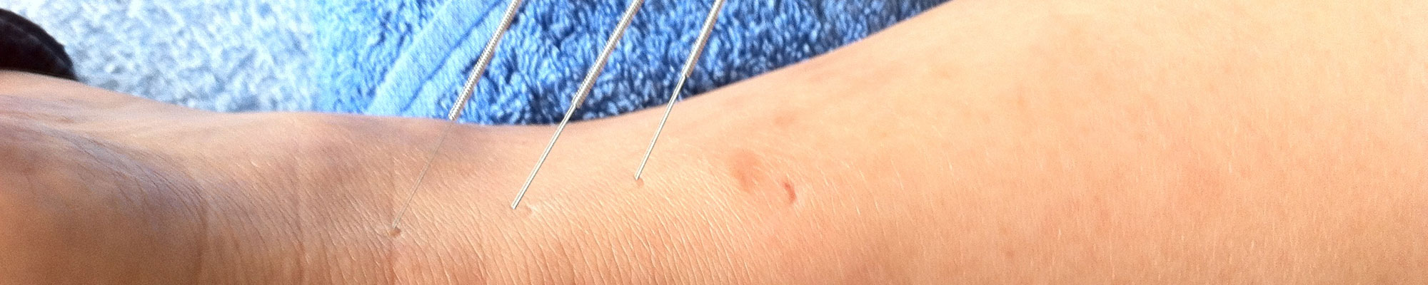 Woman having acupuncture in her wrist