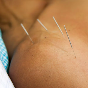Man with acupuncture needles in his shoulder