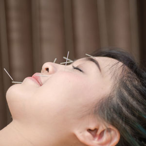 Lady having acupuncture treatment on her face